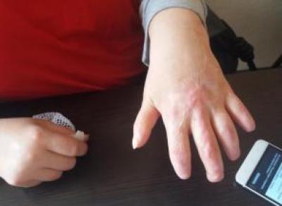 Операция по удалению аппендицита привела к ампутации фаланг пальцев