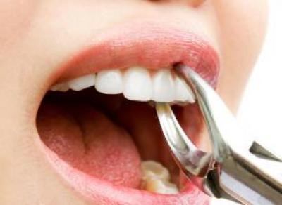 Суд вынес приговор вологодскому стоматологу за ошибочное удаление коренных зубов
